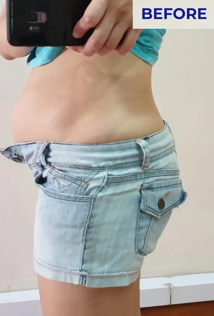 Before Weight Loss Program Singapore